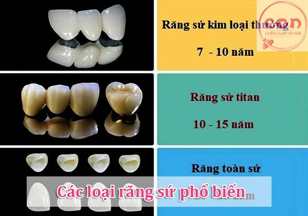 Các loại răng sứ phổ biến