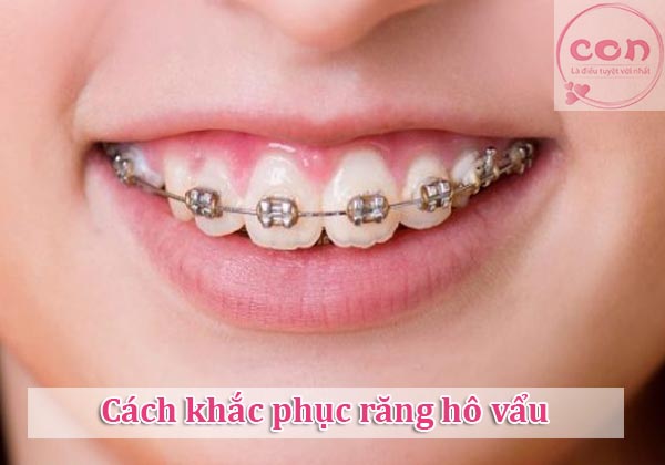 Cách khắc phục răng hô vẩu
