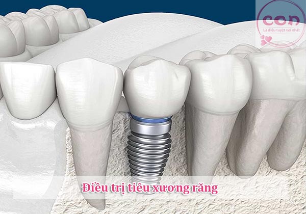 Điều trị tiêu xương răng