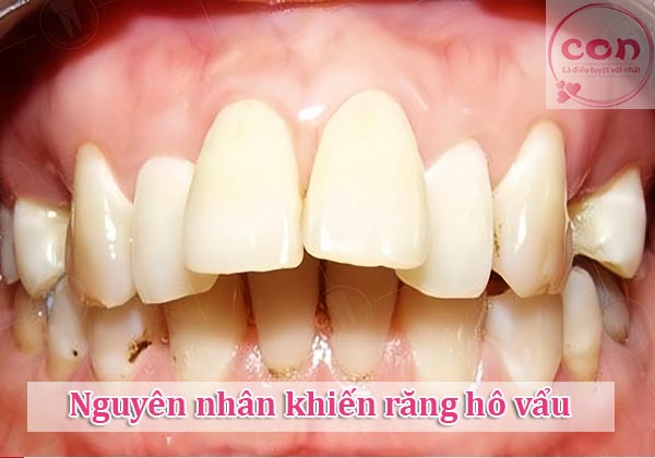 Nguyên nhân khiến răng hô vẩu