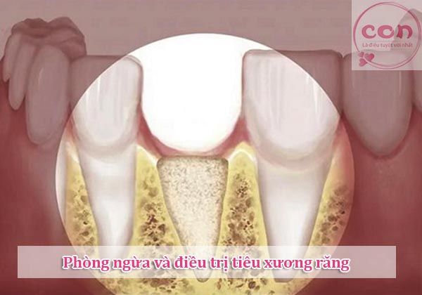 Phòng ngừa và điều trị tiêu xương răng