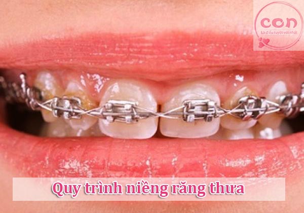 Quy trình niềng răng thưa