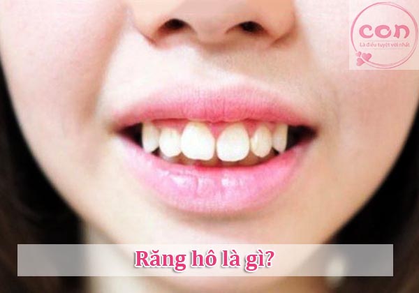 Răng hô là gì_Sotayandam