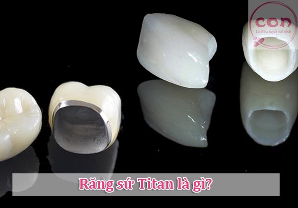 Răng sứ Titan là gì_Sotayandam