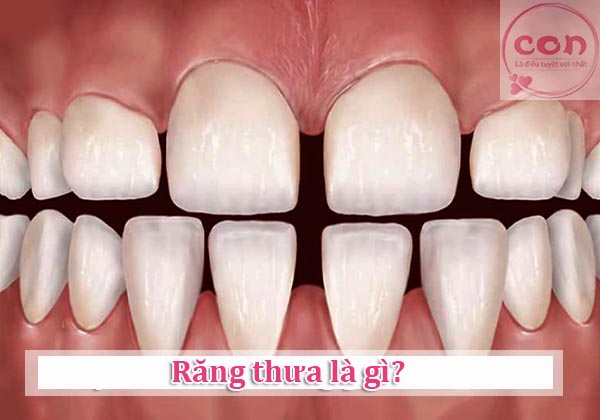 Răng thưa là gì_Sotayandam