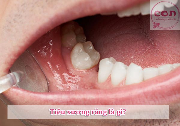 Tiêu xương răng là gì_Sotayandam