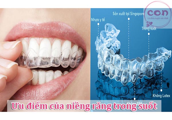 Ưu điểm của niềng răng trong suốt