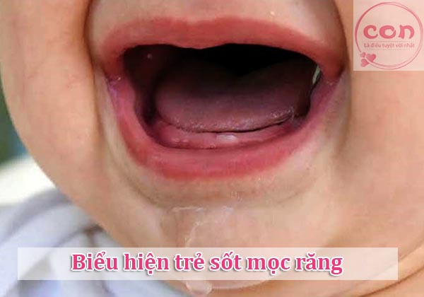 Biểu hiện trẻ sốt mọc răng