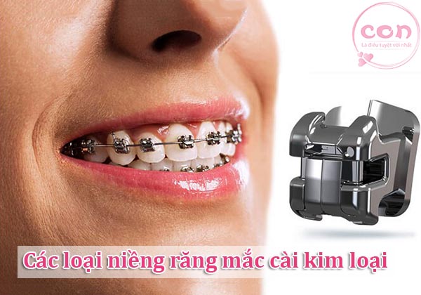 Các loại niềng răng mắc cài kim loại