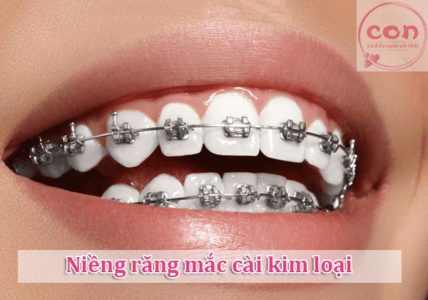 Niềng răng mắc cài kim loại
