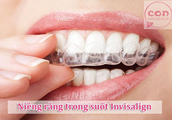 Niềng răng trong suốt Invisalign