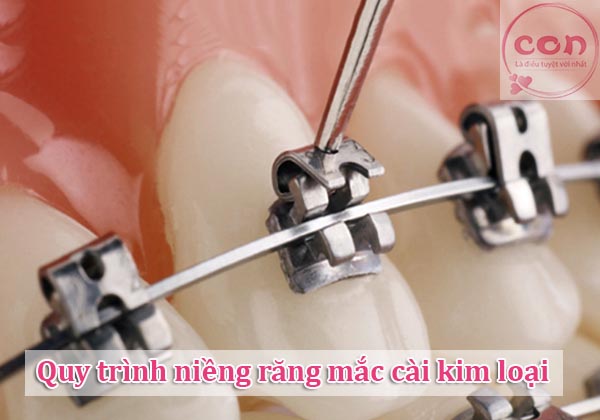 Quy trình niềng răng mắc cài kim loại