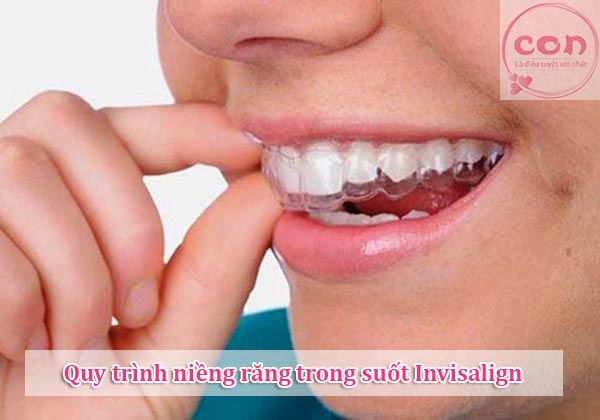 Quy trình niềng răng trong suốt Invisalign