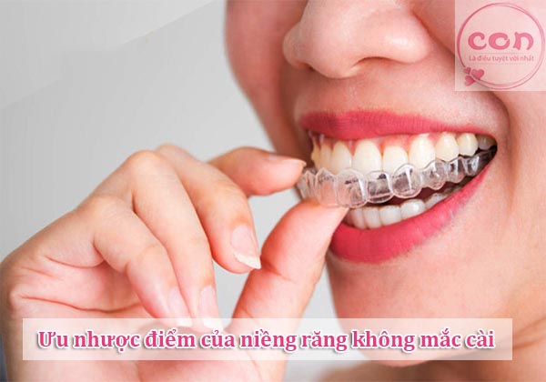 Ưu nhược điểm của niềng răng không mắc cài