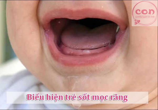 Biểu hiện trẻ sốt mọc răng