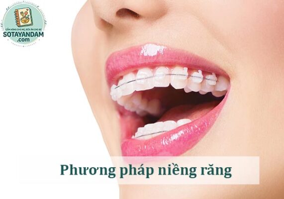 5 phương pháp niềng răng phổ biến