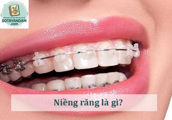 Niềng răng là gì