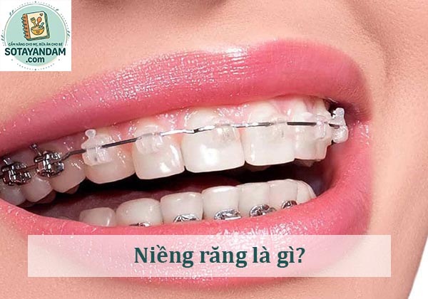 Niềng răng là gì